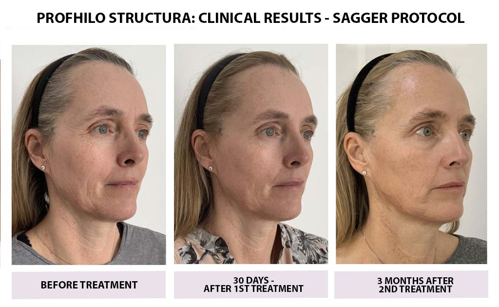 bEFORE-AND-AFTER-PROFHILO-05