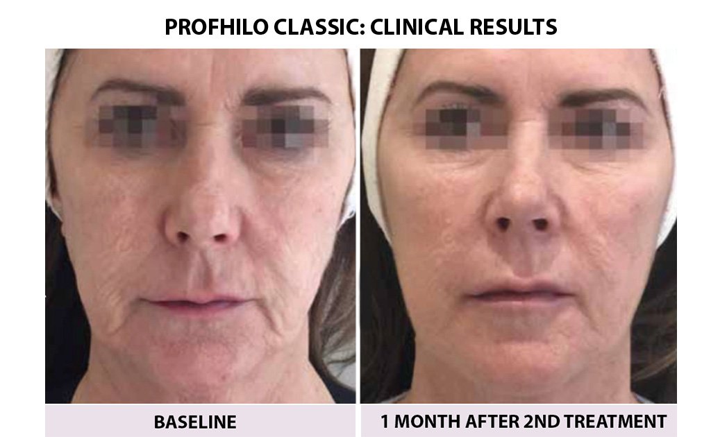 bEFORE-AND-AFTER-PROFHILO-classic
