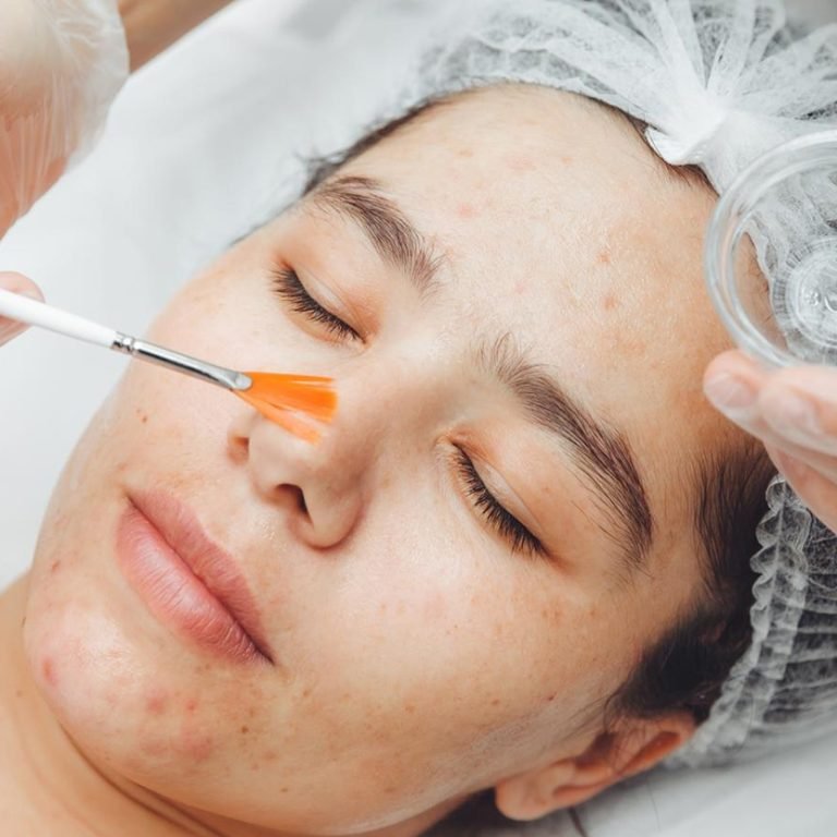 checmical-peels-featuered-image